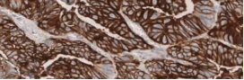 Tissue sample showing strong staining